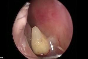 В носу китаянки вырос зуб