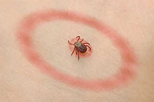 От укуса клеща годовалый ребенок заразился страшной болезнью