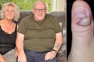 Привычка грызть ногти едва не убила 57-летнего мужчину