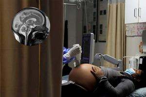 Медики пришли к выводу, что проникновение SARS-CoV-2 в организм будущих матерей не угрожает мозгу ребенка.