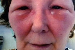 Косметолог изуродовал своих жертв, применив поддельный 