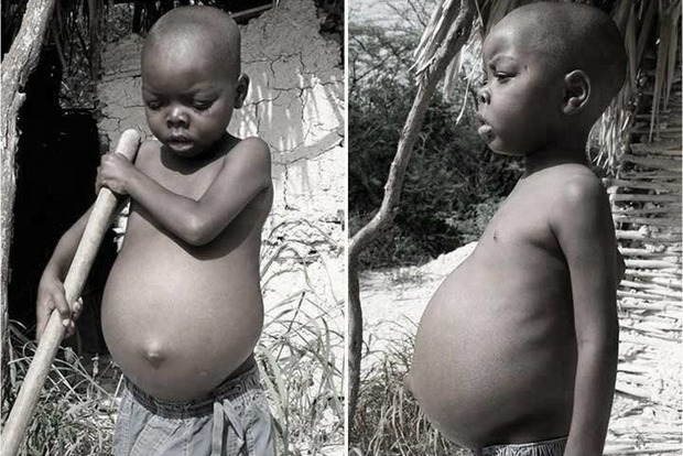 Почему у африканских детей большие животы, если они живут впроголодь