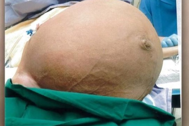 Жінці видалили пухлину матки вагою 28 кілограмів (фото 18+)