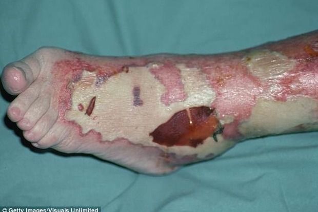 Опаснейшая кожная язва распостраняется в Австралии. Ученые бессильны (18+)