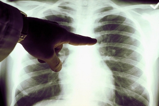6 признаков «тихой» пневмонии, которые нельзя пропустить