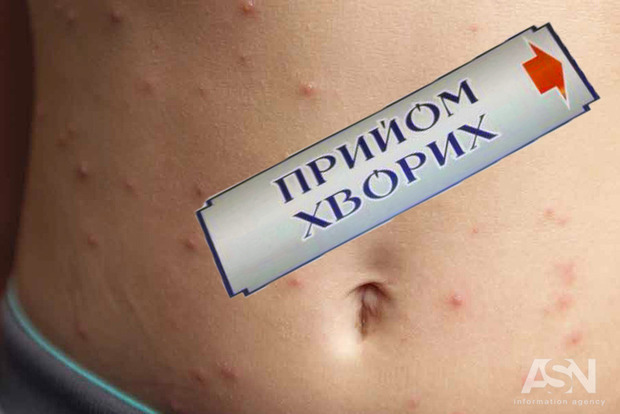 МОЗ готується оголосити епідемію кору в Україні